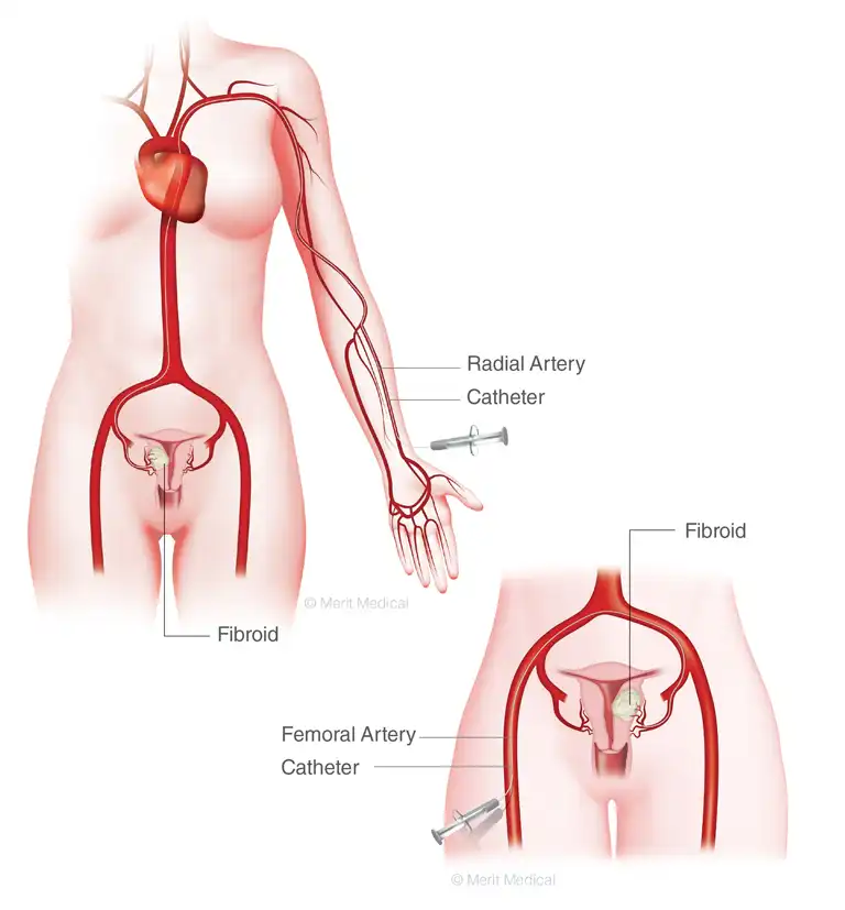 treatment of uterine fibroids with interventional radiology