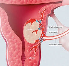 treatment of uterine fibroids with interventional radiology