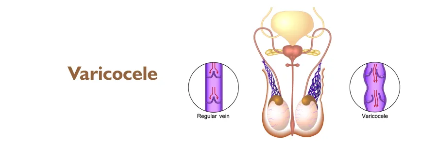 varicocele د. أحمد سعفان | أول مركز متخصص في الأشعة التداخلية في الدلتا